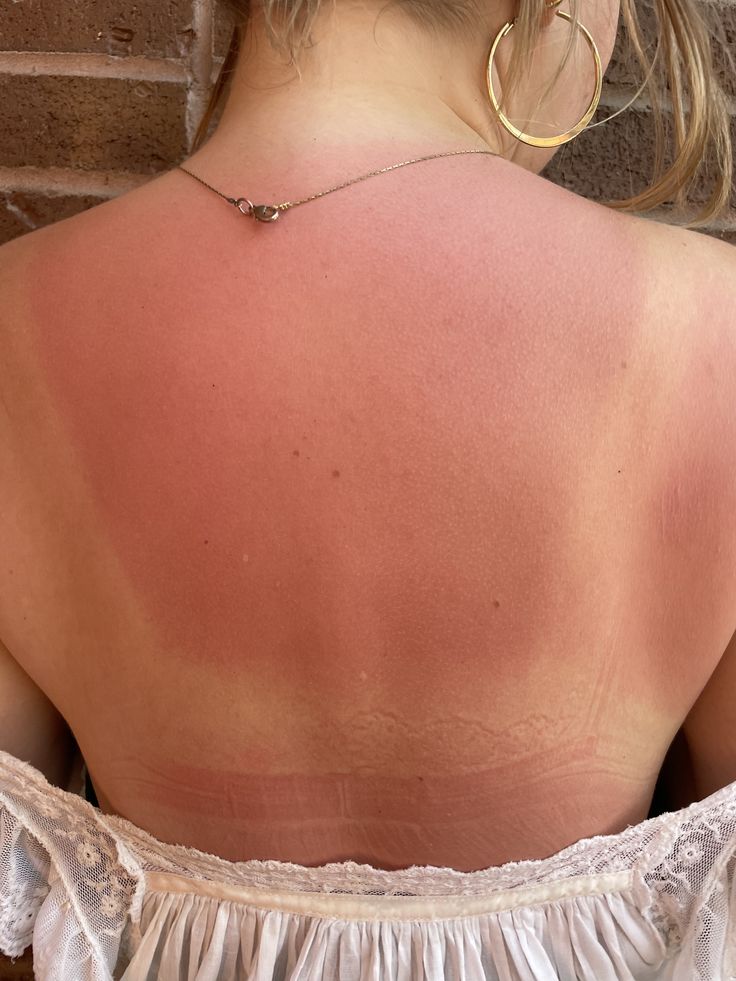 1. Chasing a Tan in the Sun: A Burn Is Damage, Not Progress